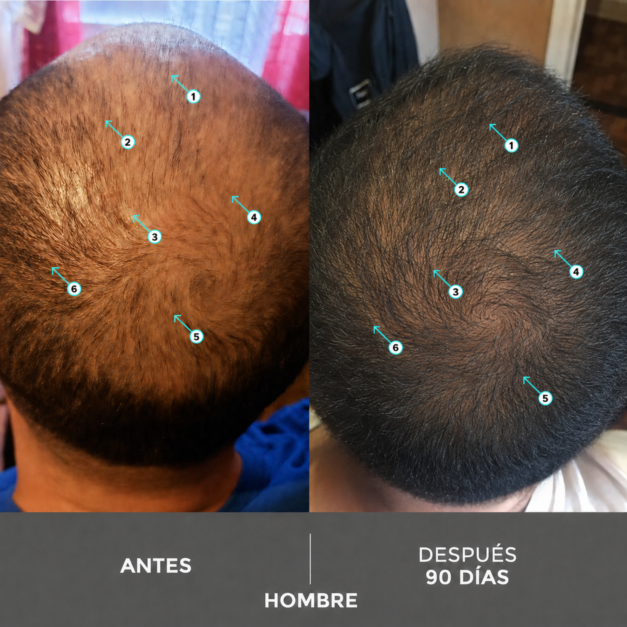 Vitali™ - Champú Densificante